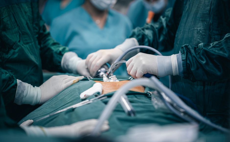 Surgical team performing laparoscopic fundoplication surgery