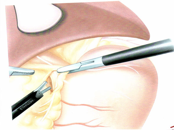 Gastric Banding