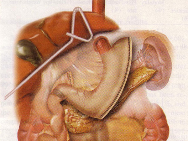 Gastric Bypass