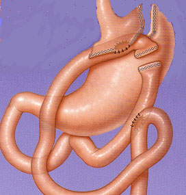 تحويل مسار المعدة المصغر (Mini Gastric Bypass)