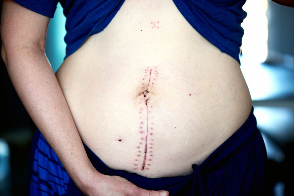 Small keyhole incisions used in laparoscopic surgery